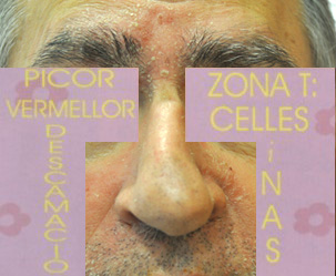 dermatitis zóna t)